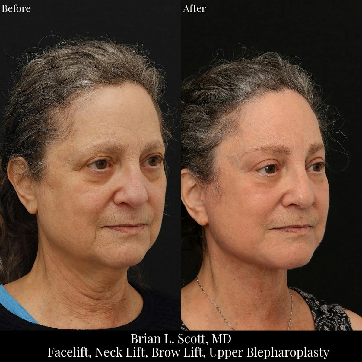 Facelift Before & After Gallery - Patient 330160 - Image 3
