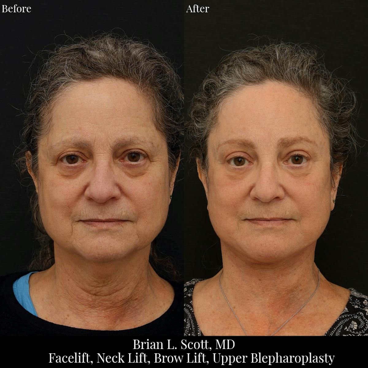 Facelift Before & After Gallery - Patient 330160 - Image 2
