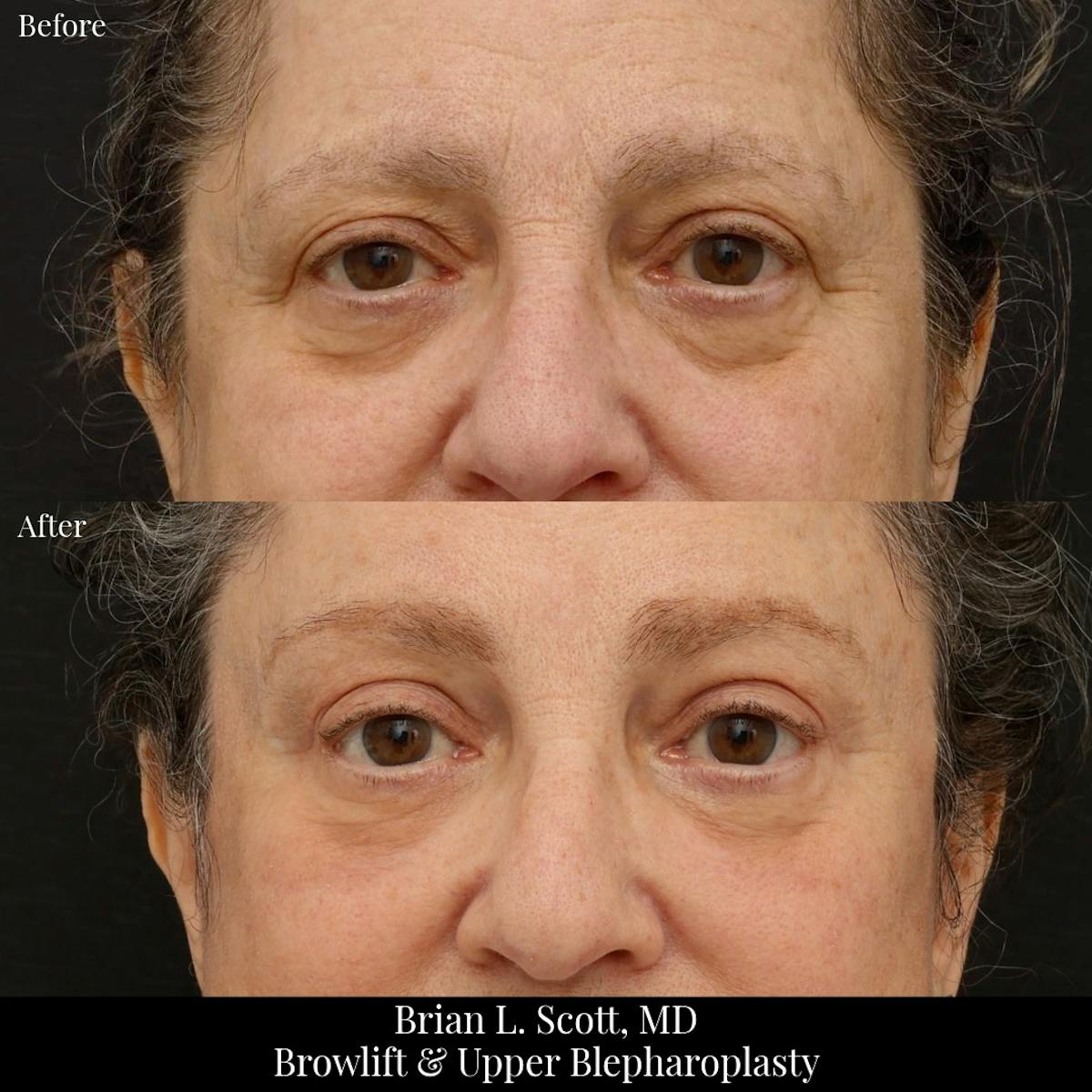 Upper Blepharoplasty Before & After Gallery - Patient 292206 - Image 1