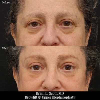 Brow Lift Before & After Gallery - Patient 205388 - Image 1