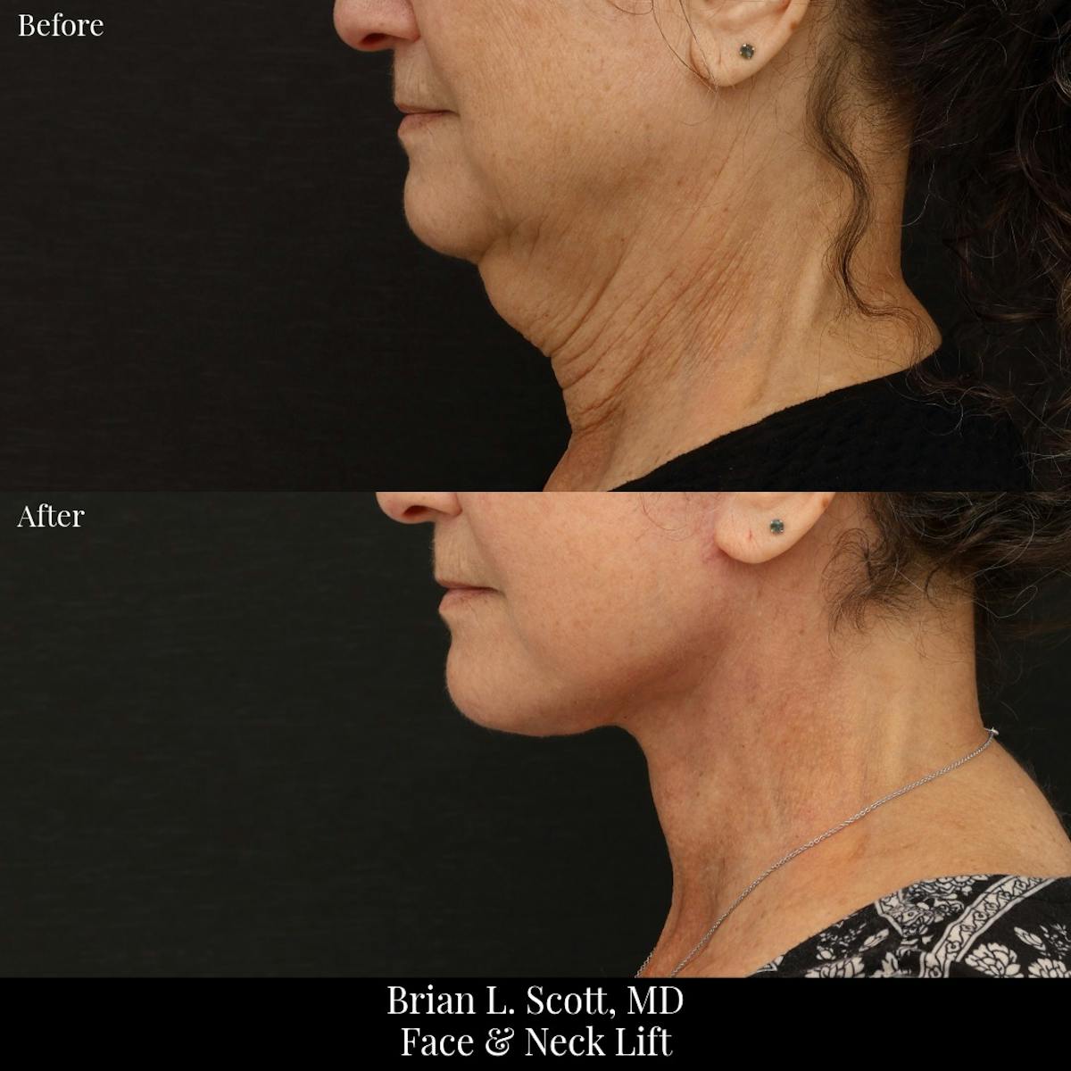 Neck Lift Before & After Gallery - Patient 142423 - Image 2
