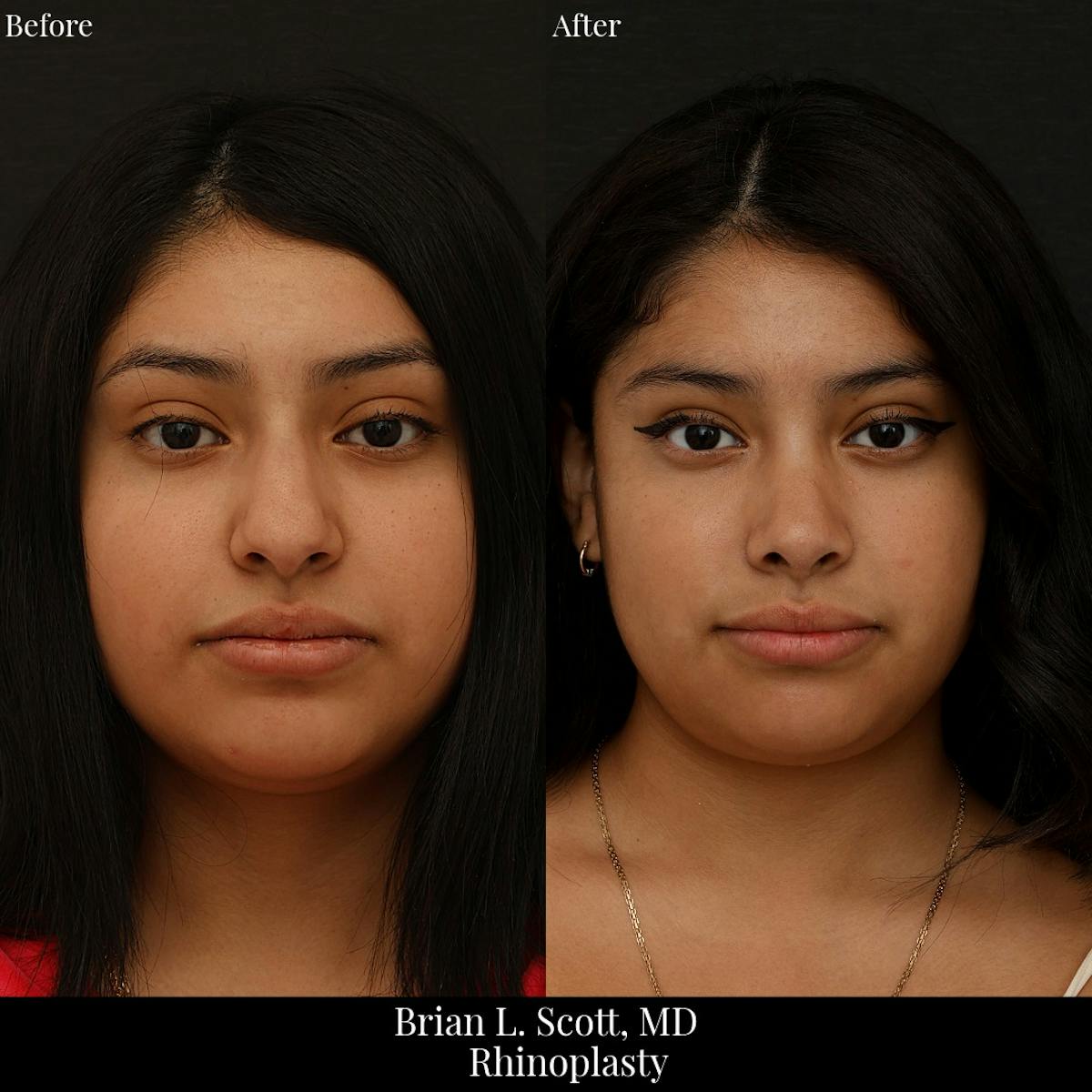 Rhinoplasty Before & After Gallery - Patient 131082 - Image 2