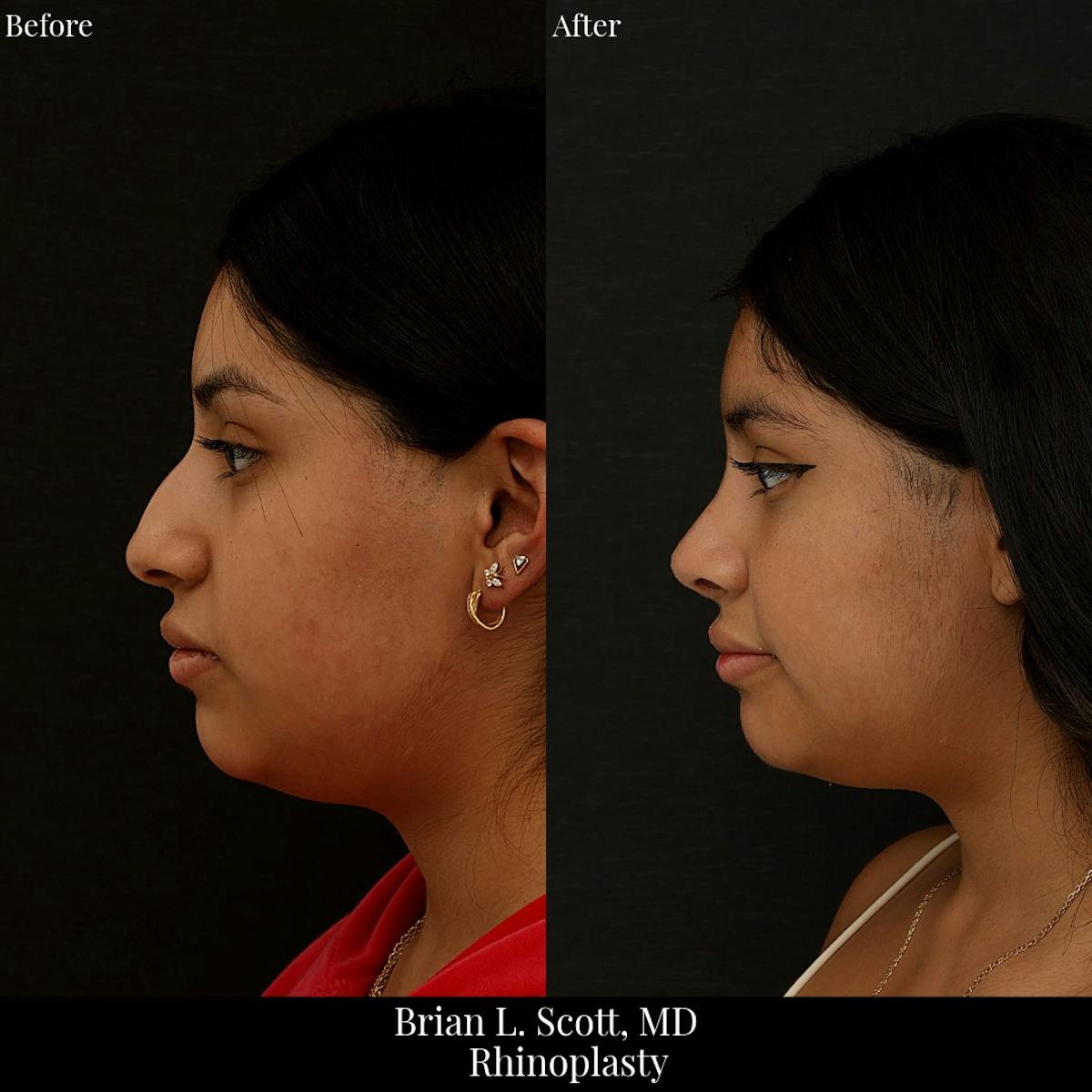 Rhinoplasty Before & After Gallery - Patient 131082 - Image 3