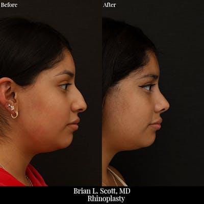 Rhinoplasty Before & After Gallery - Patient 131082 - Image 1