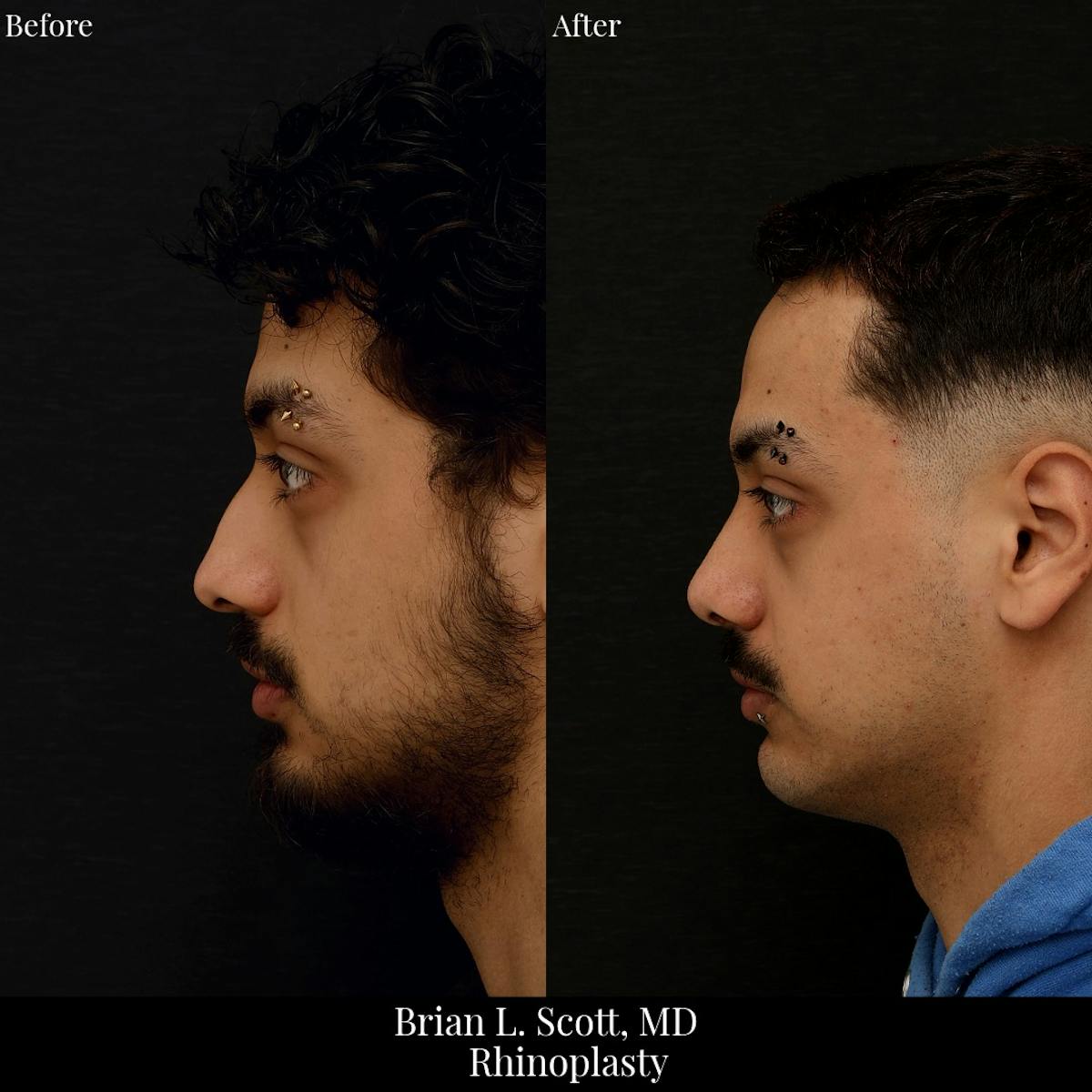 Rhinoplasty Before & After Gallery - Patient 392286 - Image 2