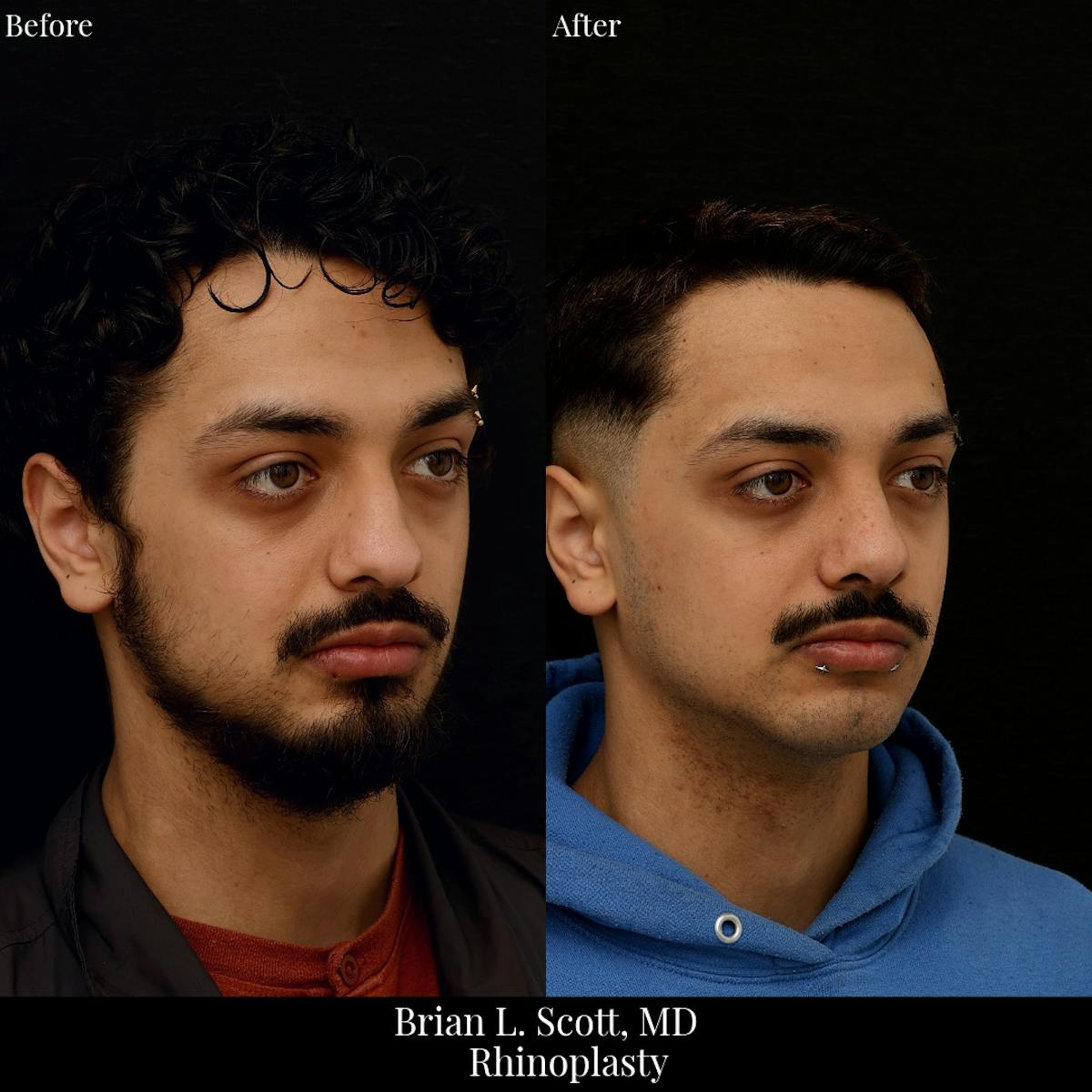 Rhinoplasty Before & After Gallery - Patient 392286 - Image 3