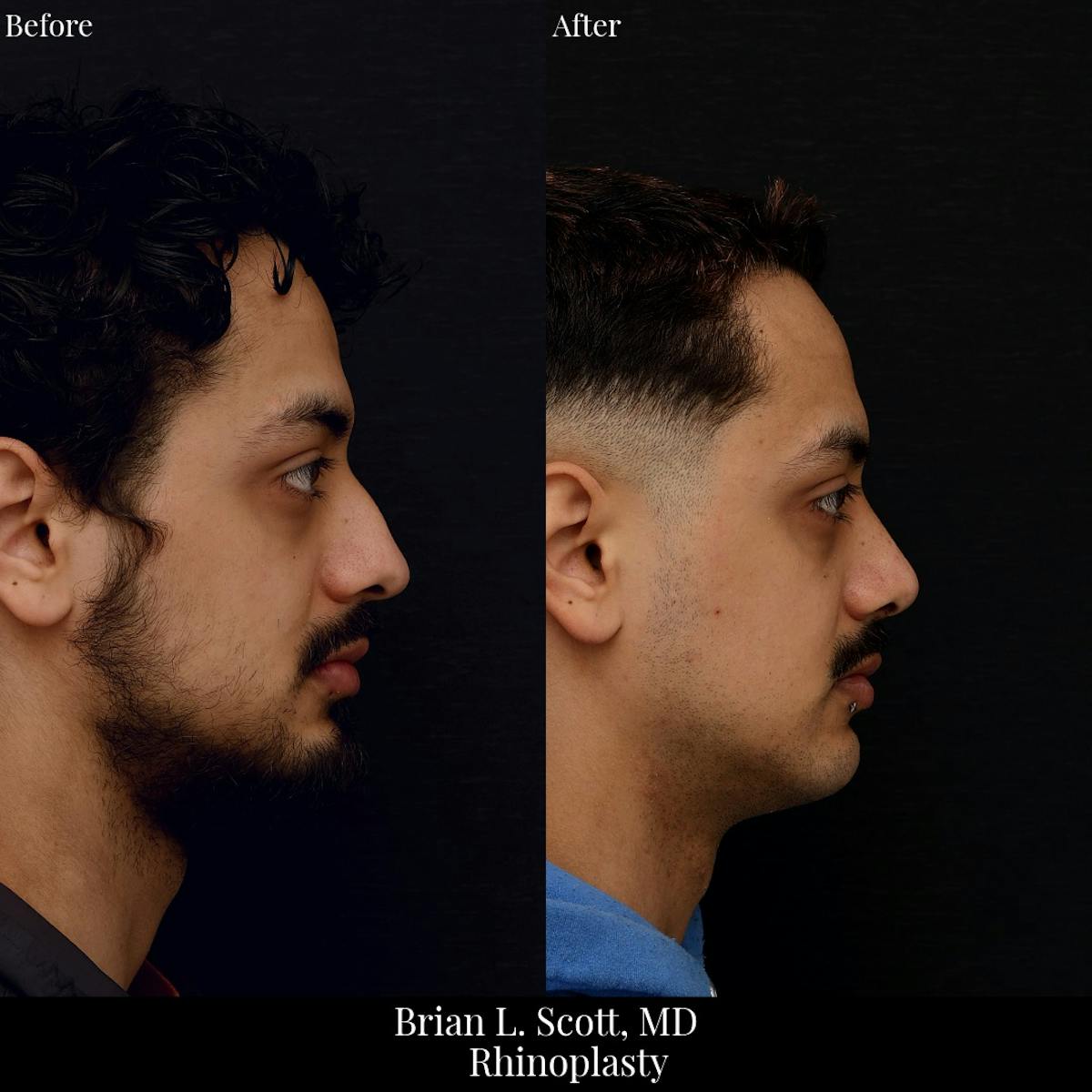 Rhinoplasty Before & After Gallery - Patient 392286 - Image 1