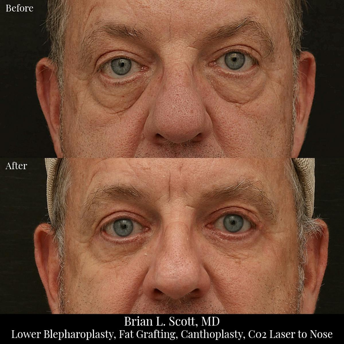 Lower Blepharoplasty Before & After Gallery - Patient 112249 - Image 1
