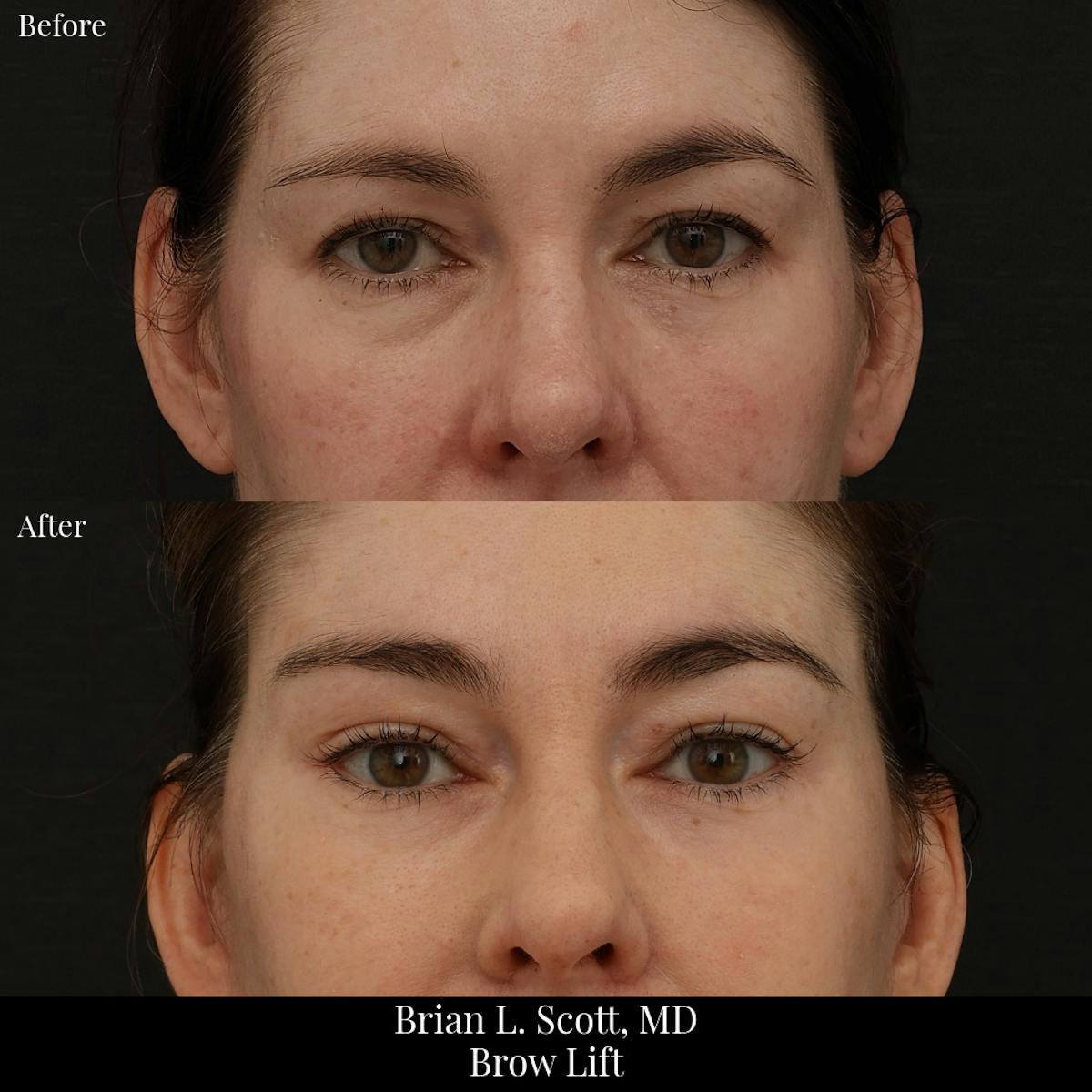 Neck Lift Before & After Gallery - Patient 165467 - Image 5