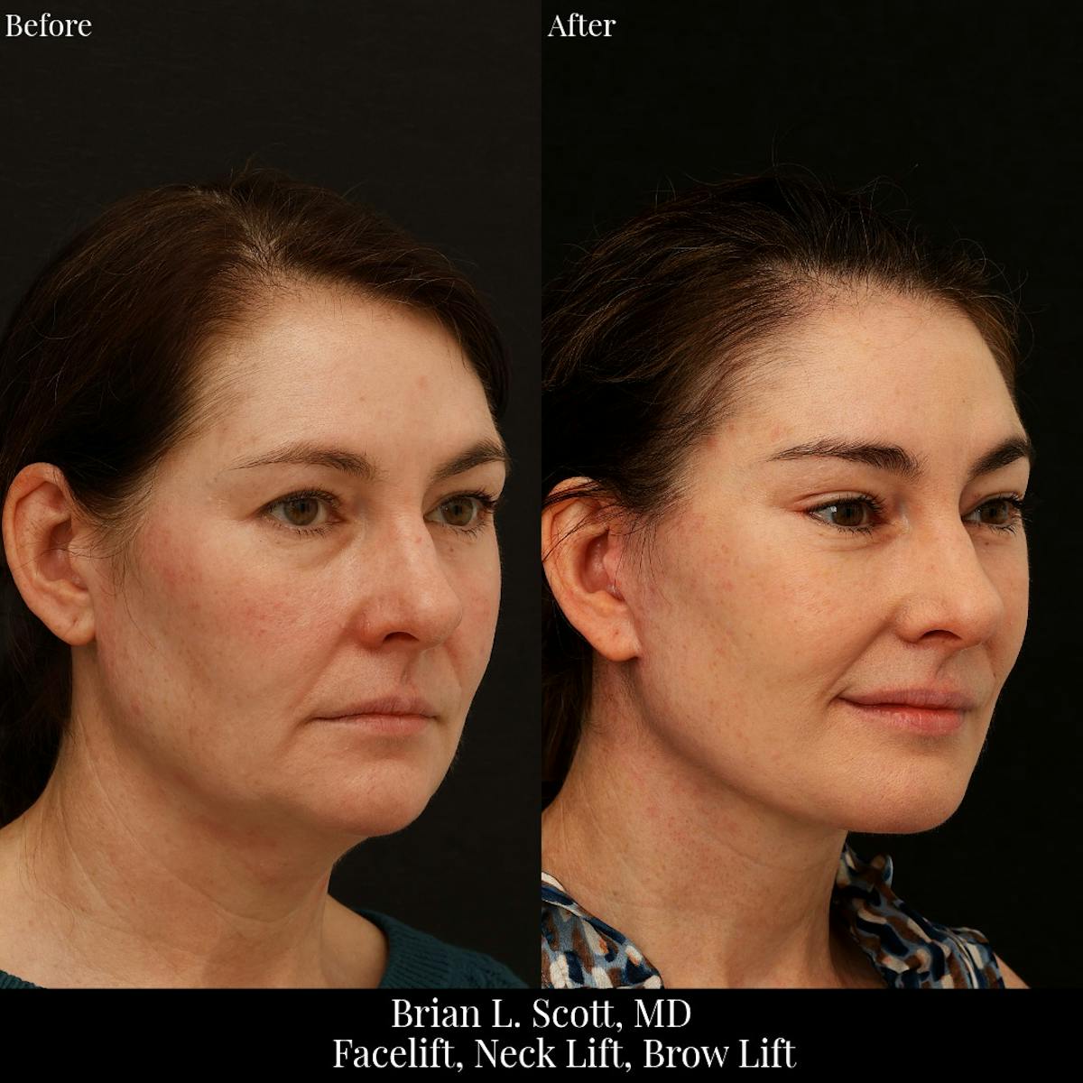Neck Lift Before & After Gallery - Patient 165467 - Image 3