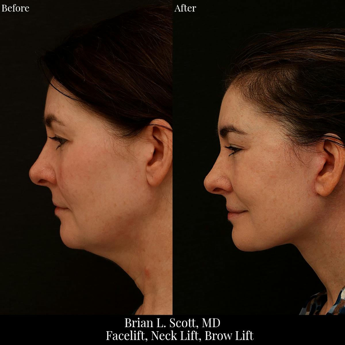 Neck Lift Before & After Gallery - Patient 165467 - Image 1