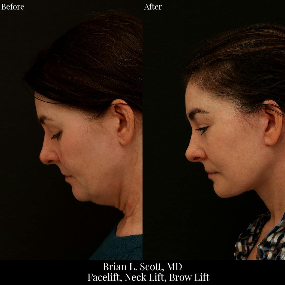Neck Lift Before & After Gallery - Patient 165467 - Image 2
