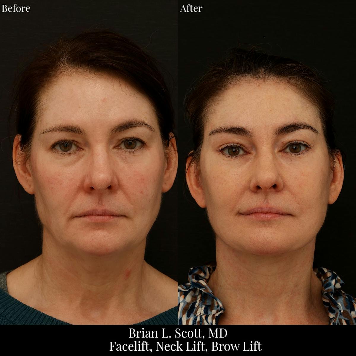 Neck Lift Before & After Gallery - Patient 165467 - Image 4