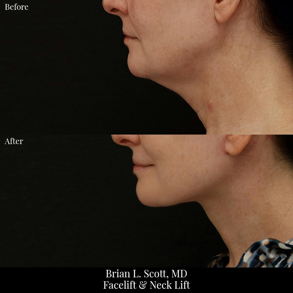 Neck Lift Before & After Gallery - Patient 165467 - Image 6