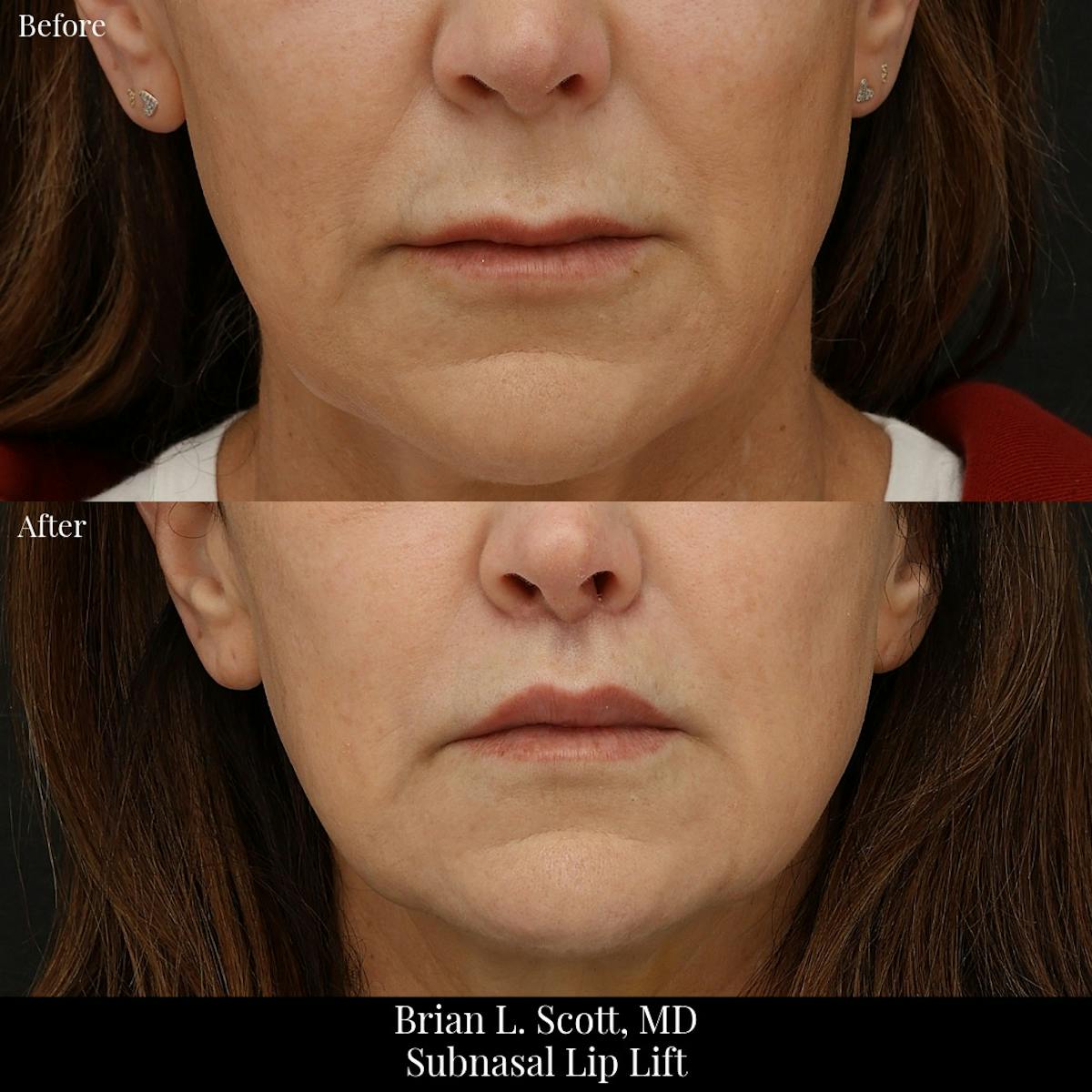 Lip Lift Before & After Gallery - Patient 161371 - Image 1