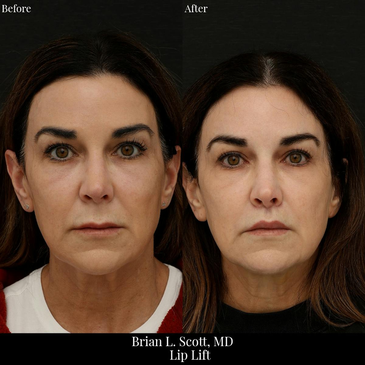Lip Lift Before & After Gallery - Patient 161371 - Image 2