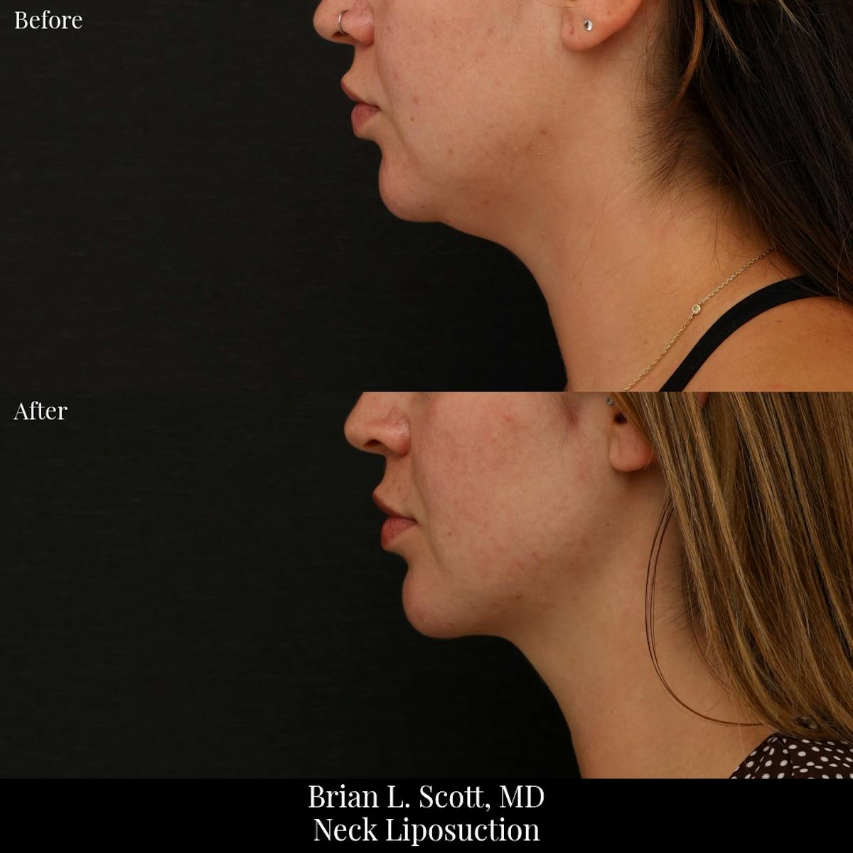 Neck Liposuction Before & After Gallery - Patient 255497 - Image 1