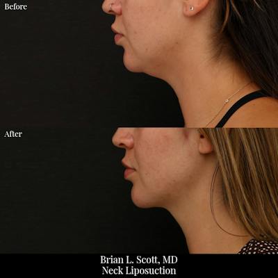 Neck Liposuction Before & After Gallery - Patient 255497 - Image 1