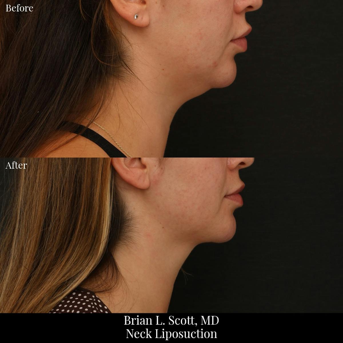 Neck Liposuction Before & After Gallery - Patient 255497 - Image 2