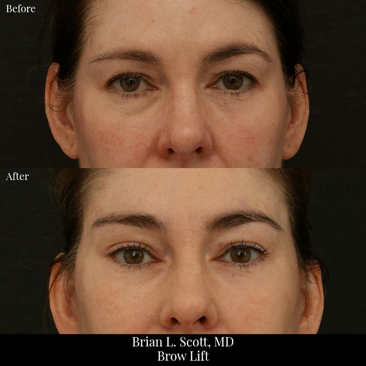 Brow Lift Before & After Gallery - Patient 143577 - Image 1