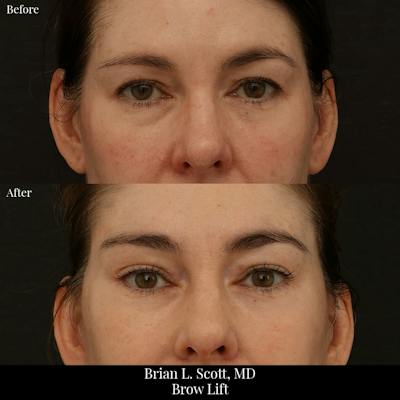 Brow Lift Before & After Gallery - Patient 143577 - Image 1