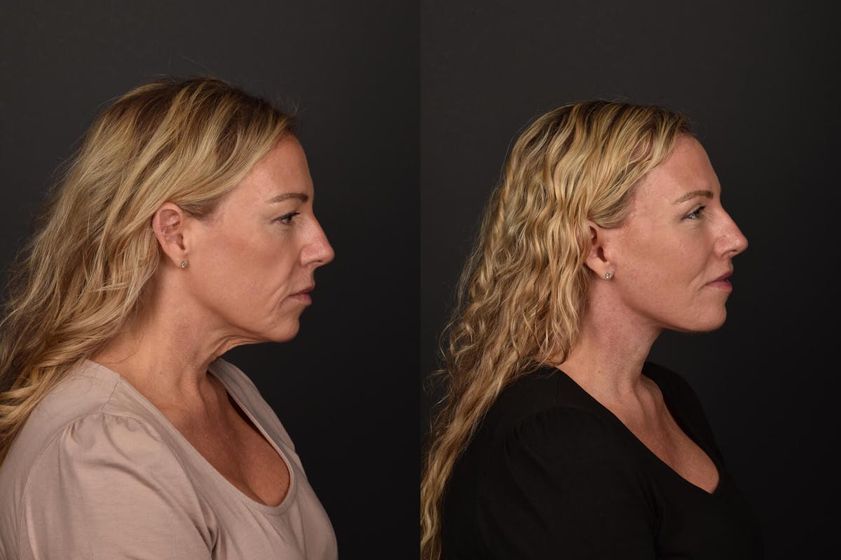 Blepharoplasty Before & After Gallery - Patient 213806 - Image 1