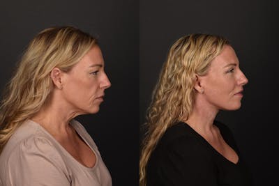 Deep Plane Facelift Before & After Gallery - Patient 117908 - Image 1