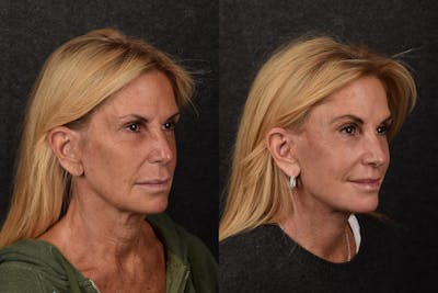 Lower Eyelid Skin Pinch  Before & After Gallery - Patient 297429 - Image 1