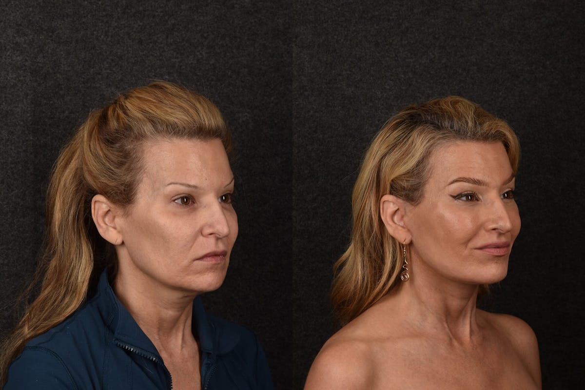 Lip Lift Before & After Gallery - Patient 626410 - Image 2