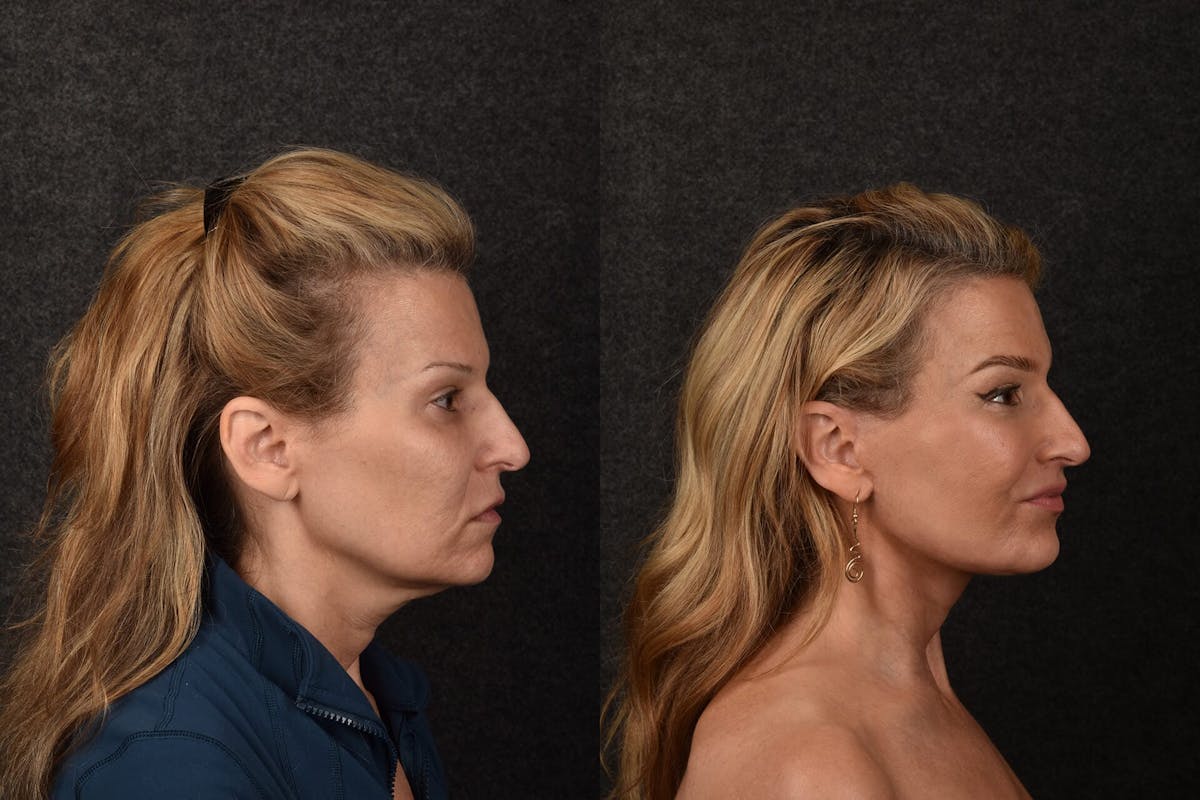 Lip Lift Before & After Gallery - Patient 626410 - Image 1