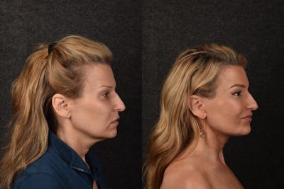 Deep Plane Facelift Before & After Gallery - Patient 323217 - Image 1