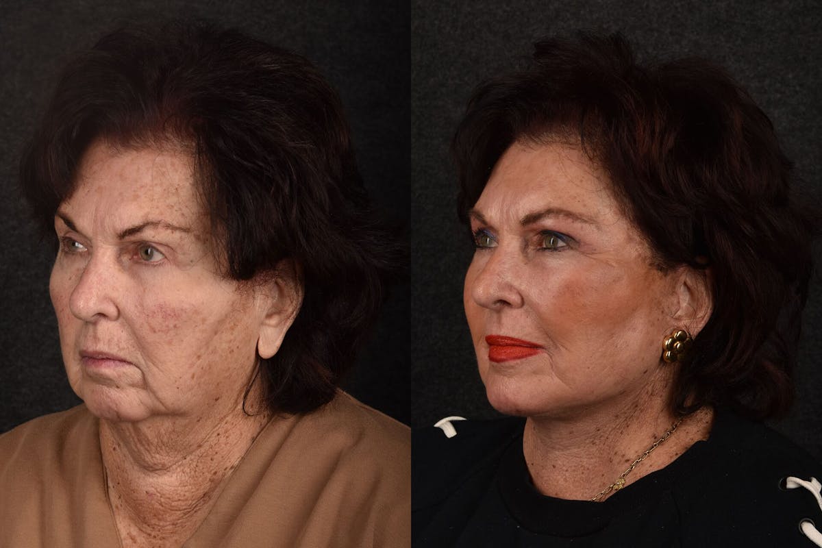 CO2 Laser Treatment Before & After Gallery - Patient 374999 - Image 1