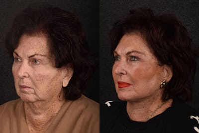 Deep Plane Facelift Before & After Gallery - Patient 245338 - Image 1