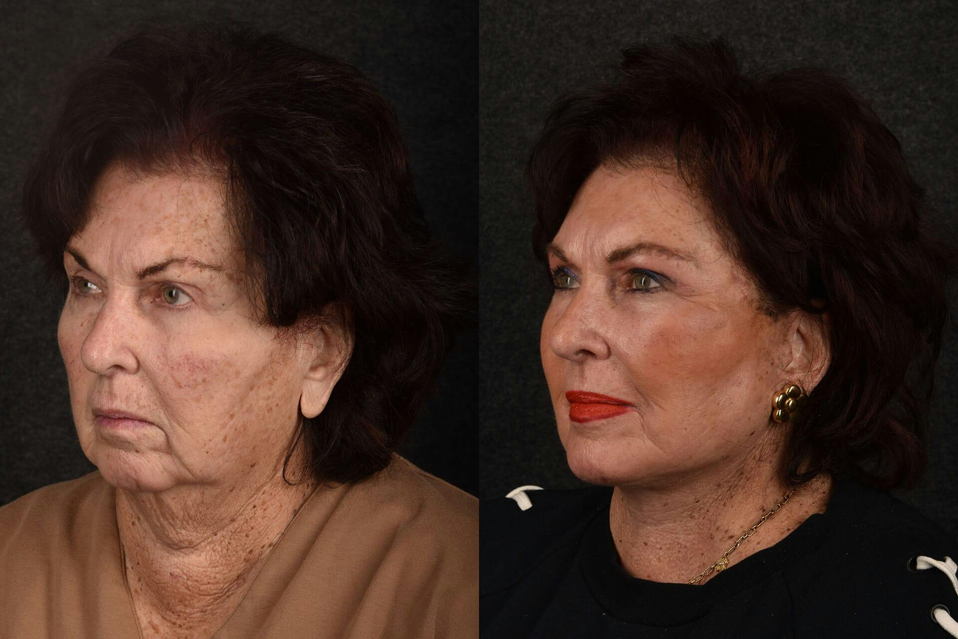 Facial Rejuvenation Before & After Gallery - Patient 522946 - Image 1