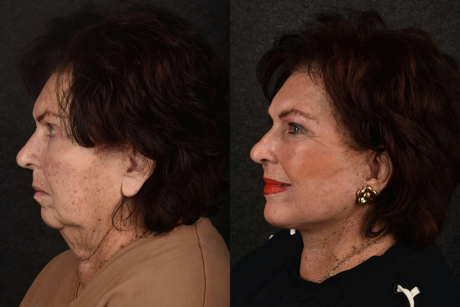 Facial Rejuvenation Before & After Gallery - Patient 522946 - Image 2