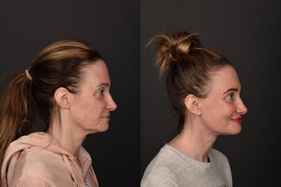 Deep Plane Facelift Before & After Gallery - Patient 302403 - Image 1