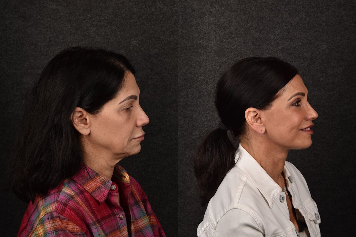 Blepharoplasty Before & After Gallery - Patient 297809 - Image 1