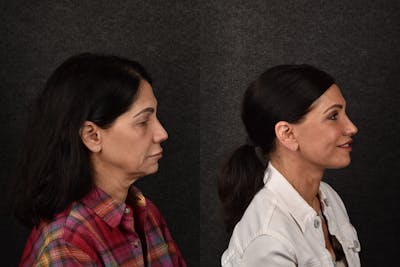 Deep Plane Facelift Before & After Gallery - Patient 316407 - Image 1