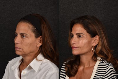 Deep Plane Facelift Before & After Gallery - Patient 368642 - Image 1