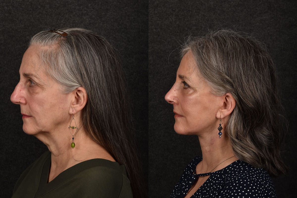 CO2 Laser Treatment Before & After Gallery - Patient 102080 - Image 1