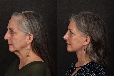 Deep Plane Facelift Before & After Gallery - Patient 148072 - Image 1