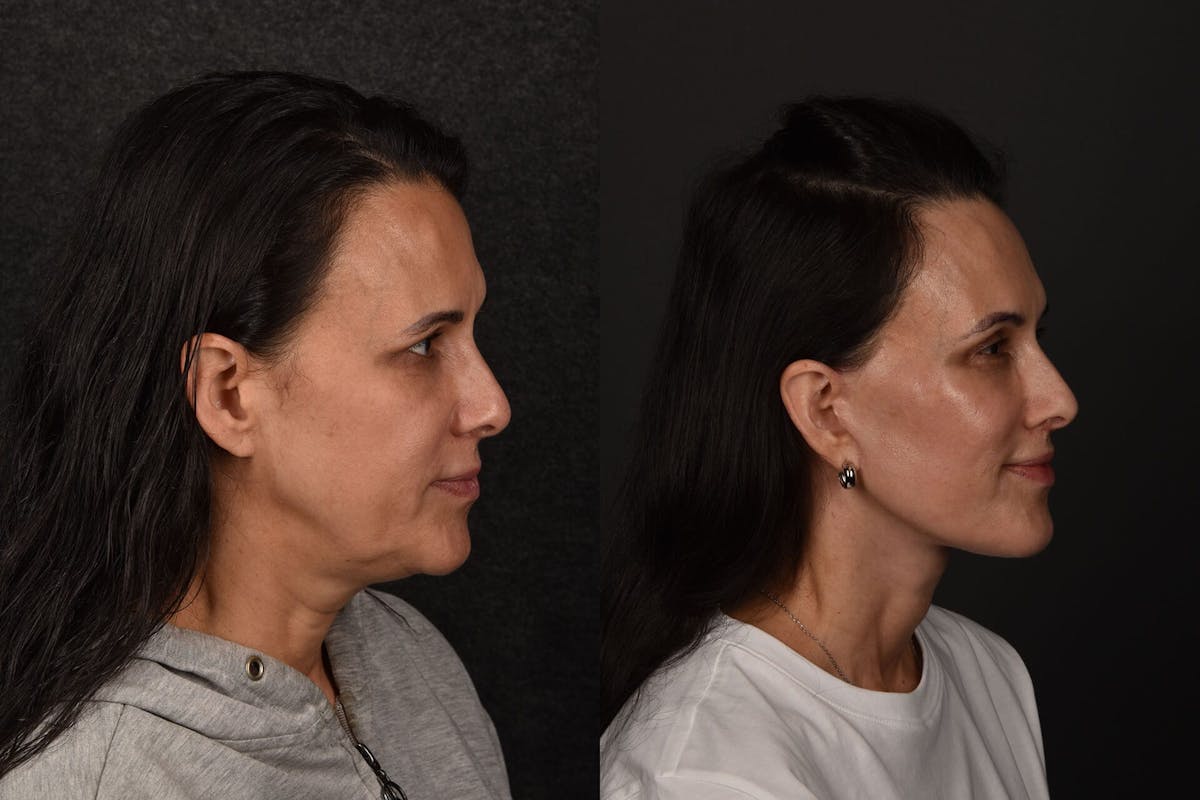 Lip Lift Before & After Gallery - Patient 357507 - Image 2