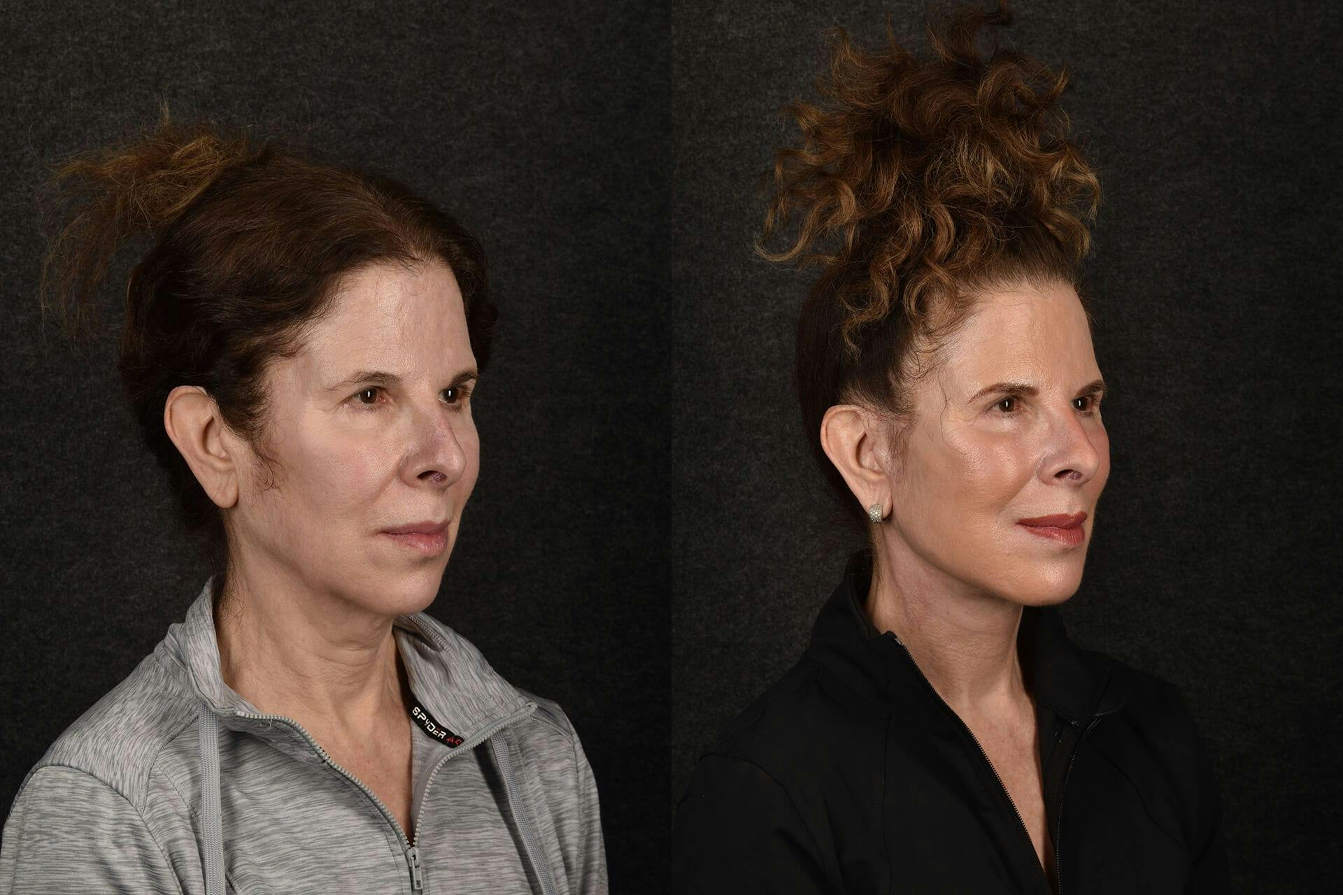 Deep Plane Facelift Before & After Gallery - Patient 141330 - Image 1