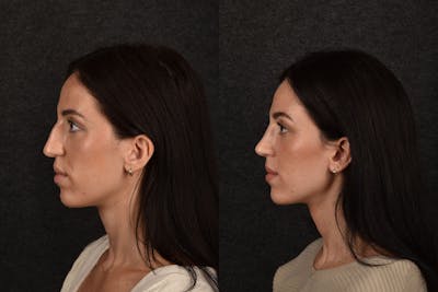 Rhinoplasty Before & After Gallery - Patient 403724 - Image 1