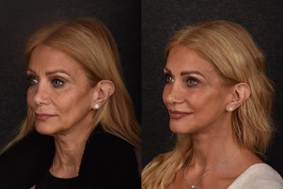 Deep Plane Facelift Before & After Gallery - Patient 237097 - Image 1