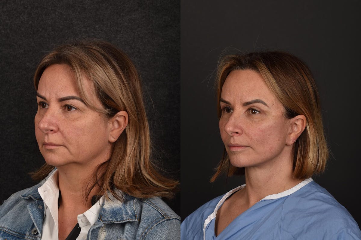Lip Lift Before & After Gallery - Patient 162858 - Image 1