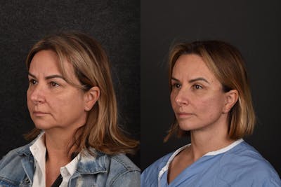 Deep Plane Facelift Before & After Gallery - Patient 185208 - Image 1