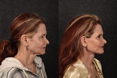 Deep Plane Facelift Before & After Gallery - Patient 229033 - Image 1