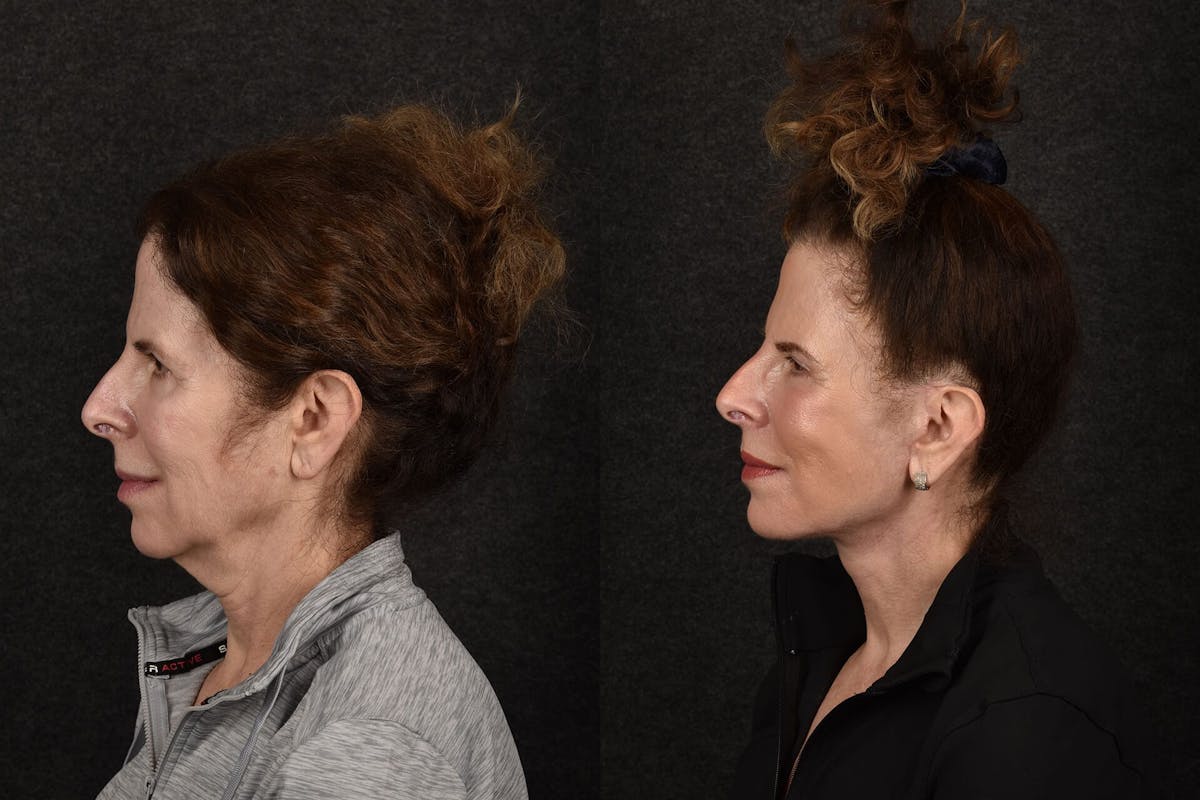Blepharoplasty Before & After Gallery - Patient 355947 - Image 2