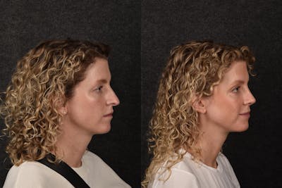 Rhinoplasty Before & After Gallery - Patient 268248 - Image 1